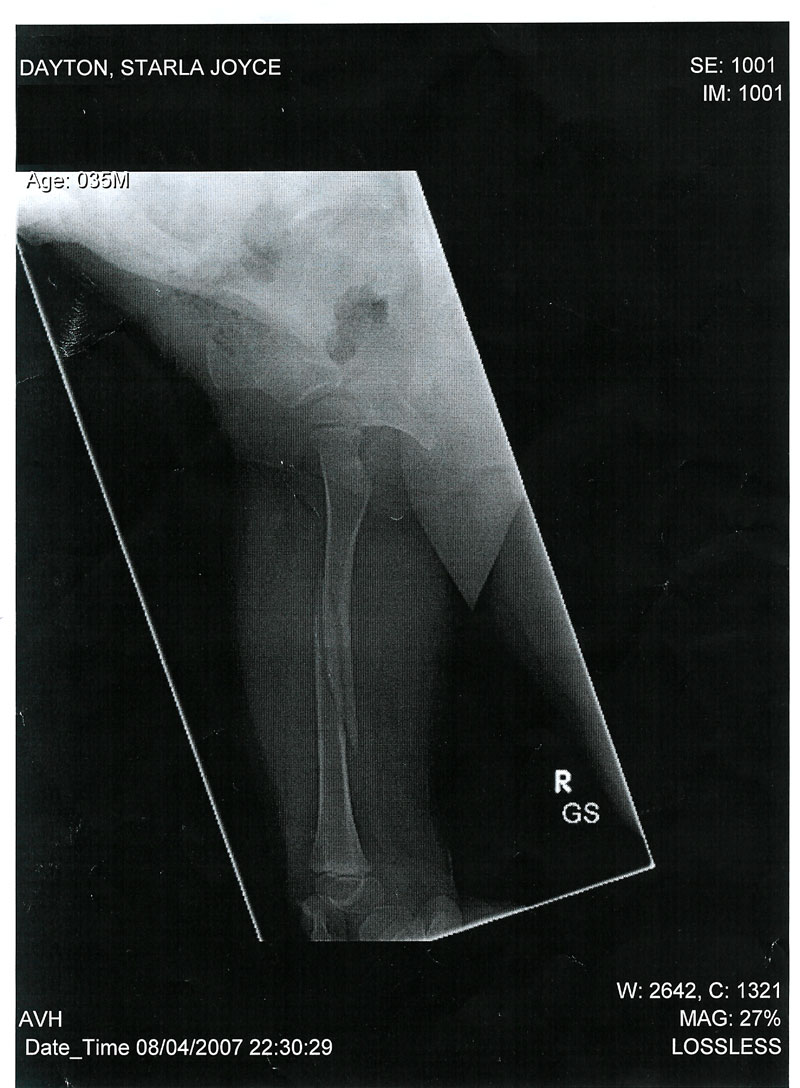 Starla's Fracture